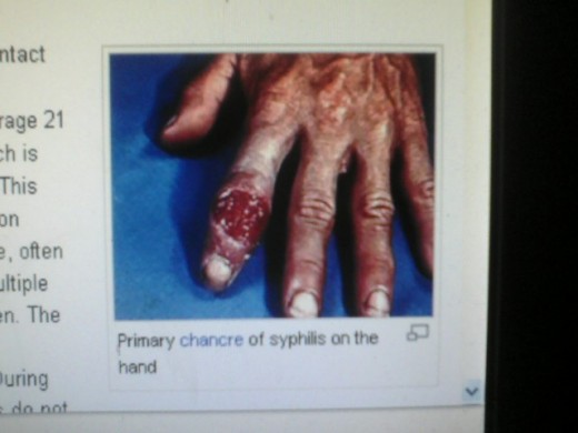 A picture of Syphilis in it's late stages, when it eat the holes into the flesh.