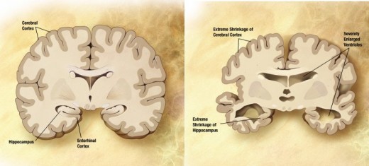 Brain Slice Comparison. Right: Normal Brain. Left: Alzheimer's Affacted Brain. Image Source Wikicommons.