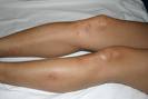 Flea bites: heck, I'd like a chance at those legs myself.  Hope this didn't happen at one of tripadviser's hotels!            photo tripadvisor.com