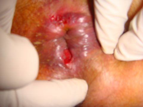 anal fissure
