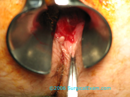 anal fissure