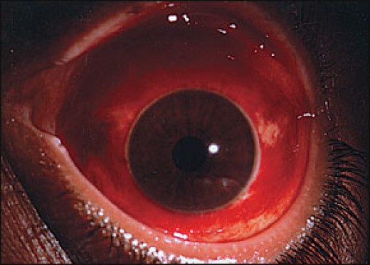 what-causes-broken-or-burst-blood-vessels-in-the-eyes