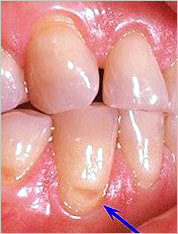 Tooth erosion 1800dentist.com