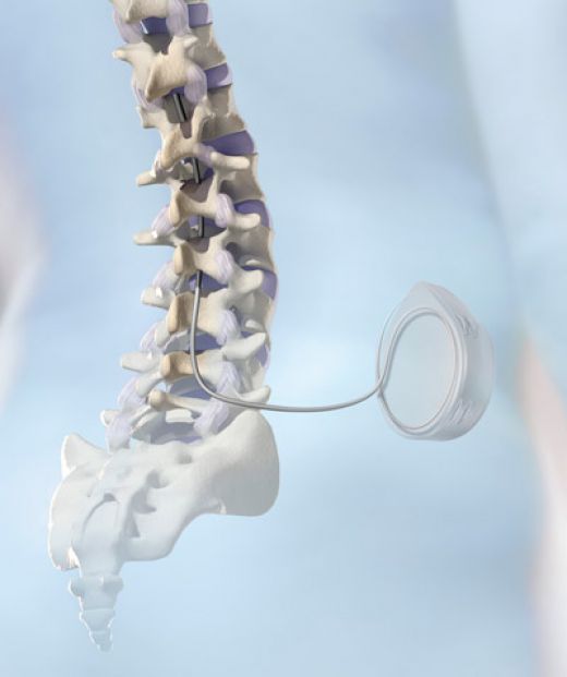 Side view of Baclofen Pump and view of catheter into the spine.