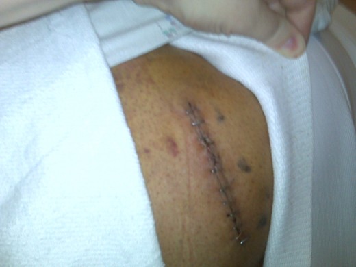 Left Rear Buttocks Incision