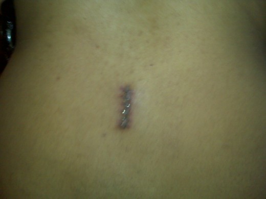 Lower Spine Incision