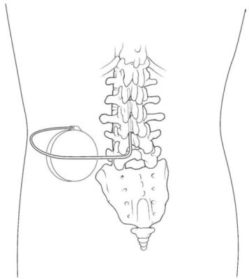 Rear Photo of Intrathecal Baclofen Pump