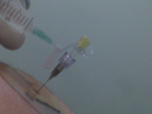 Doctor extracting the saline from the pump and then refilling the pump with Baclofen.