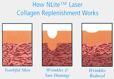 The additional stimulation of collagen, over time, gradually fills in the "gaps" reducing the effects of wrinkling and acne scarring