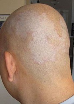 How to Get Rid of Dandruff Naturally Using Essential Oils | HubPages