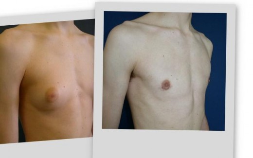 male breast reduction surgery before and after
