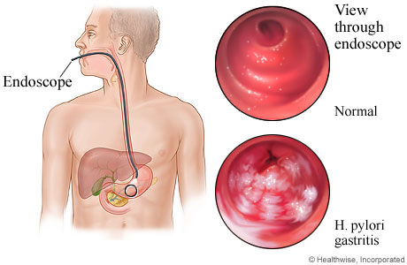 Helicobacter pylori infection