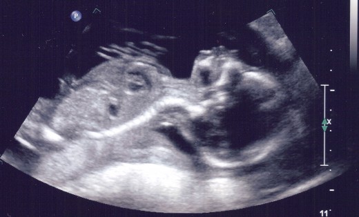 20 week ultrasound photo of unborn baby girl