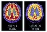 Normal Brain vs.  Overly Stimulated Brain