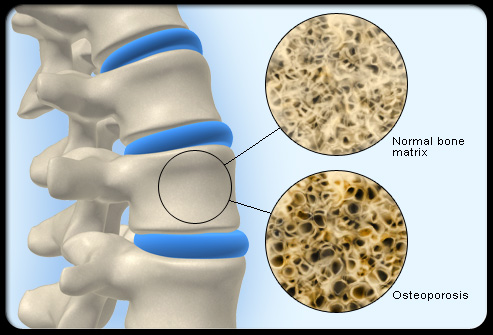 Parallel between normal, trabecular structure in the non-osteoporotic bone (above) and the reduced trabeculae of the osteoporotic bone (below).