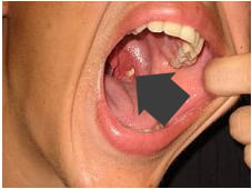 tonsilstone on tonsil