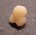 Irregular shaped tonsil stone