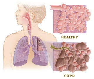 This illustration shows the respiratory system and cross-sections of healthy alveoli (air sacs) and aveoli with COPD