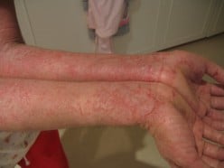 Can Chinese Medicine Cure Eczema?