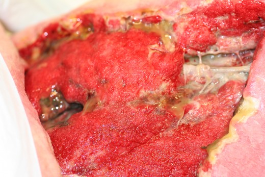This is a huge necrotic wound infected by bacteria in the thigh of an elderly lady.