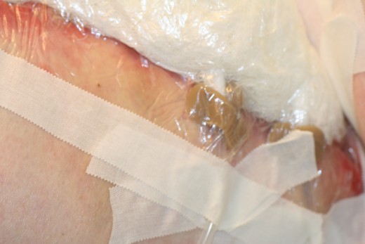 The transparent film was reinforced with 3m sportstape