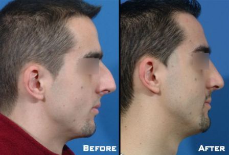 Nose reshaping is a popular male cosmetic surgery procedure.