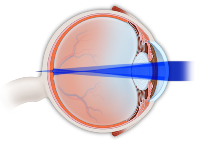 Astigmatism  