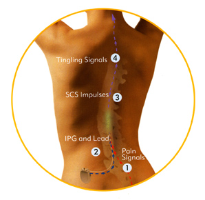 How spinal cord stimulator implant works?