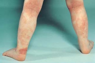Baby Eczema on the Legs