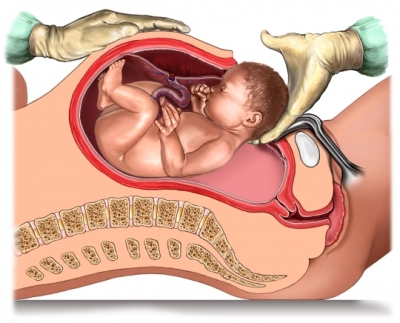 Preterm cesarean section for complete placenta previa
