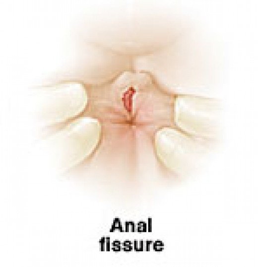 cream-for-anal-fissure