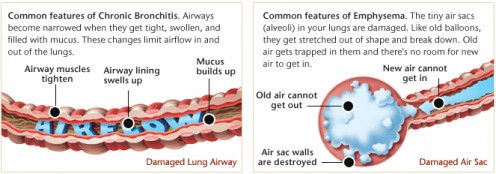 Lungs with COPD; Chronic Obstructive Pulmonary Disease