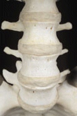 Orthopedic Disk Fusion - Allow Fusion on your spine or not