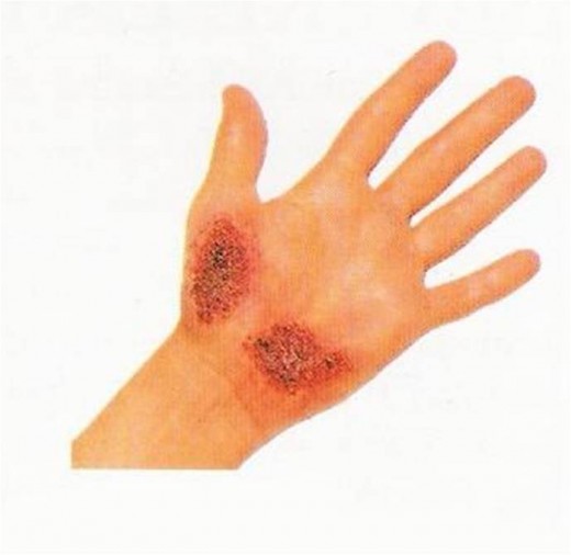 Abrasion