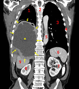 CT scan of a patient with mesothelioma. The yellow arrows indicate the mesothelioma and the central pleural fluid collection is marked with a yellow star.