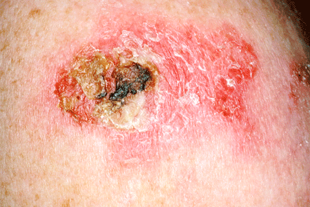 skin cancer