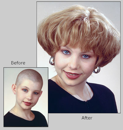 Rosemary oil treats alopecia pic