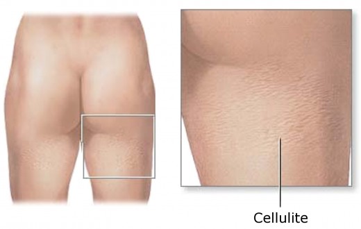 Cellulite treatments help reduce and eliminate the visible effects of cellulite.