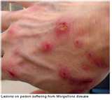 This is a picture of general inflammation of an infection and IS NOT related to HIV or AIDS
