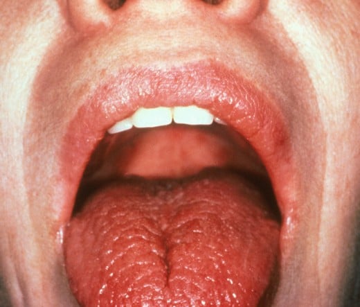 Dry mouth in autoimmune disorders and diabetes.
