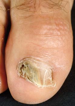 Don't let you nail infection get this bad.