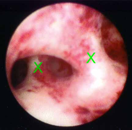 Uterine perforations found on hysteroscopy