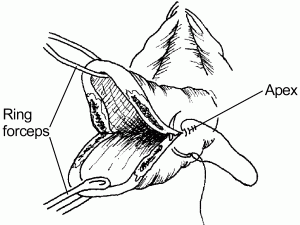 Cervical tear surgery