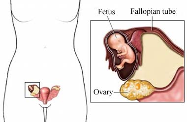 Ectopic pregnancy chart
