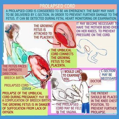 Understanding umbilical cord prolapse