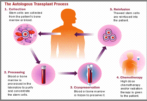 How Stem Cell Transplantation is done?