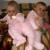 Polish conjoined or Siamese twins Polish conjoined or Siamese twins