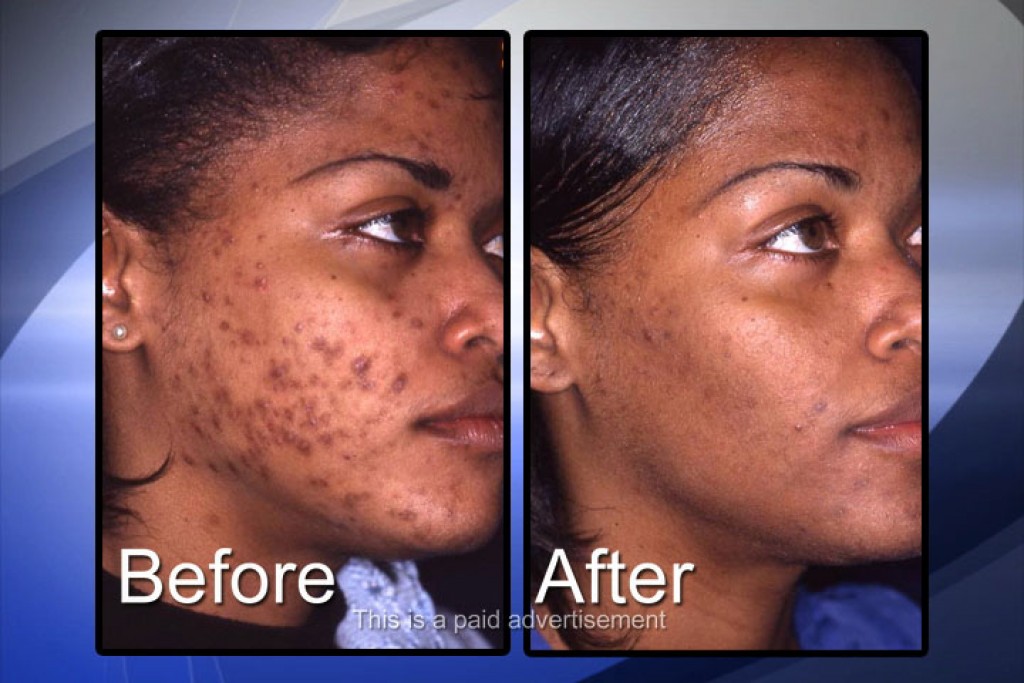 hormonal-imbalance-acne-treatment