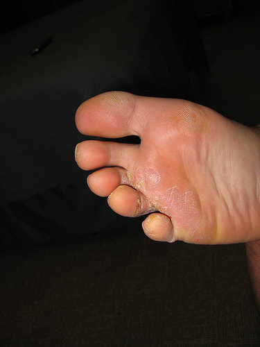 Bad Case of Athlete's Foot