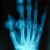 Plain radiograph showing chronic tophaceous gouty arthritis in the hands. Plain radiograph showing chronic tophaceous gouty arthritis in the hands.